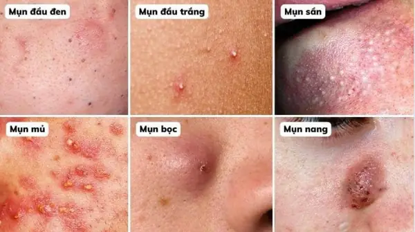 Nhận Biết Các Loại Mụn Trứng Cá Và Cách Chăm Sóc Hiệu Quả