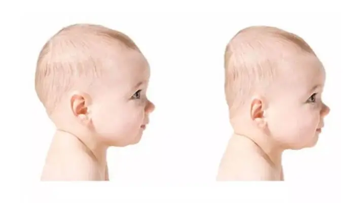 Đầu Bẹp Cá Trê Ở Trẻ Sơ Sinh: Nguyên Nhân, Nhận Biết Và Cách Khắc Phục Hiệu Quả