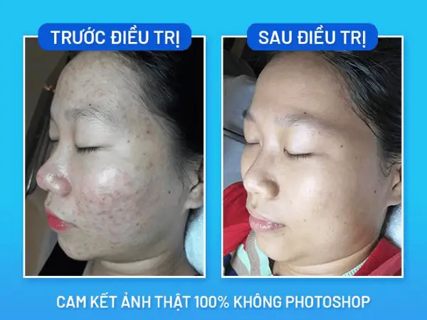 Uống Cafe Nhiều Có Nổi Mụn Không